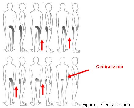 Ejemplo de centralización en columna lumbar.